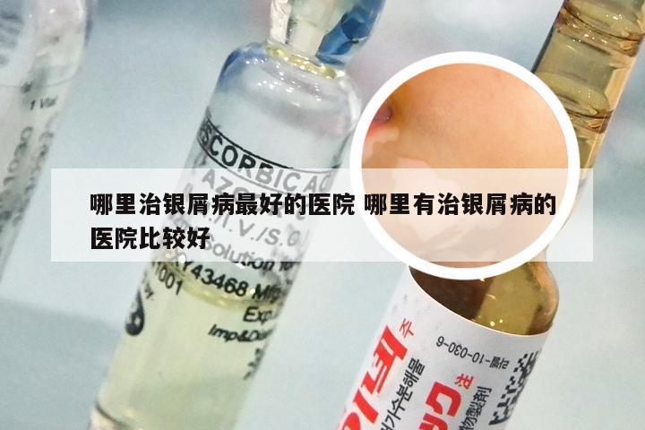 哪里治银屑病最好的医院 哪里有治银屑病的医院比较好