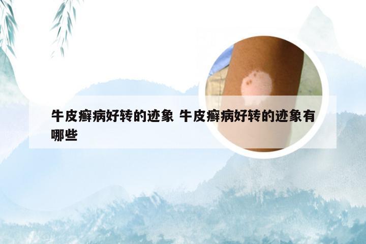 牛皮癣病好转的迹象 牛皮癣病好转的迹象有哪些