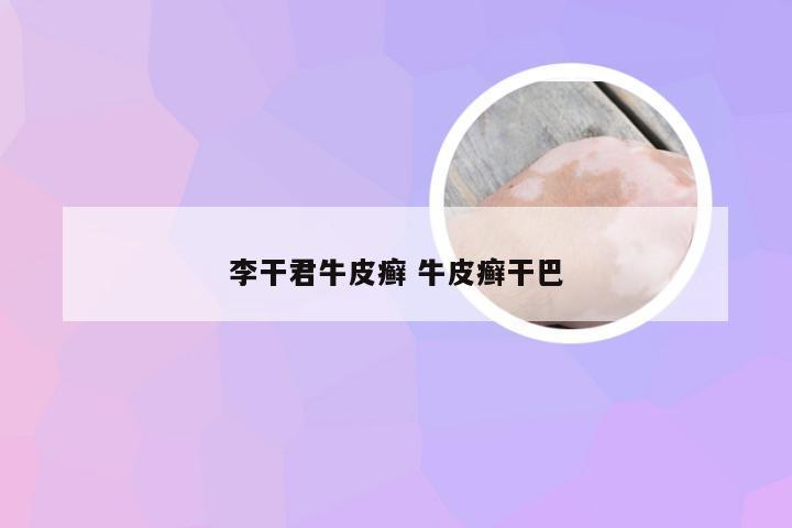 李干君牛皮癣 牛皮癣干巴