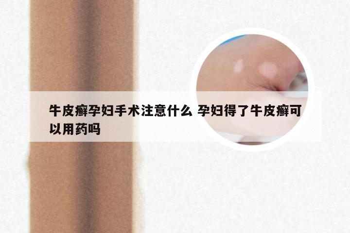 牛皮癣孕妇手术注意什么 孕妇得了牛皮癣可以用药吗