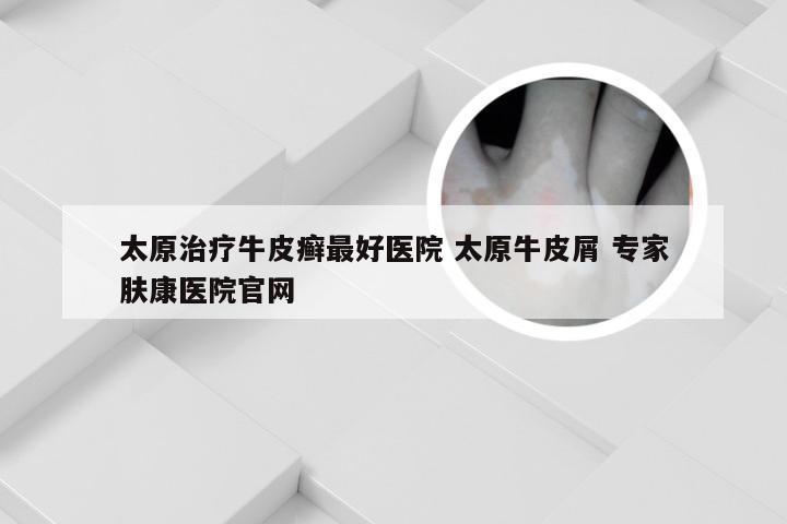太原治疗牛皮癣最好医院 太原牛皮屑 专家肤康医院官网
