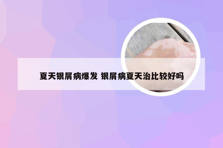 夏天银屑病爆发 银屑病夏天治比较好吗