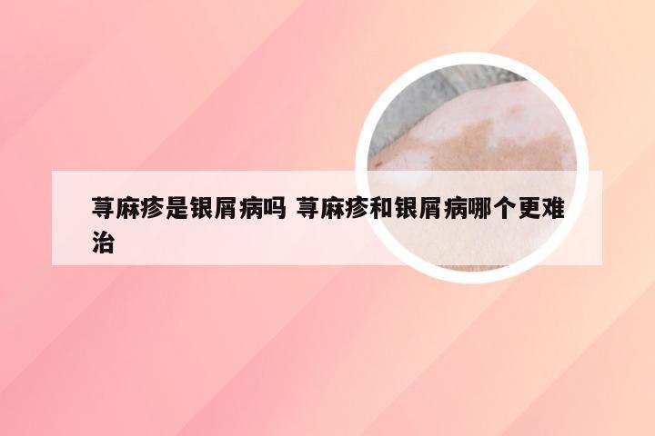 荨麻疹是银屑病吗 荨麻疹和银屑病哪个更难治