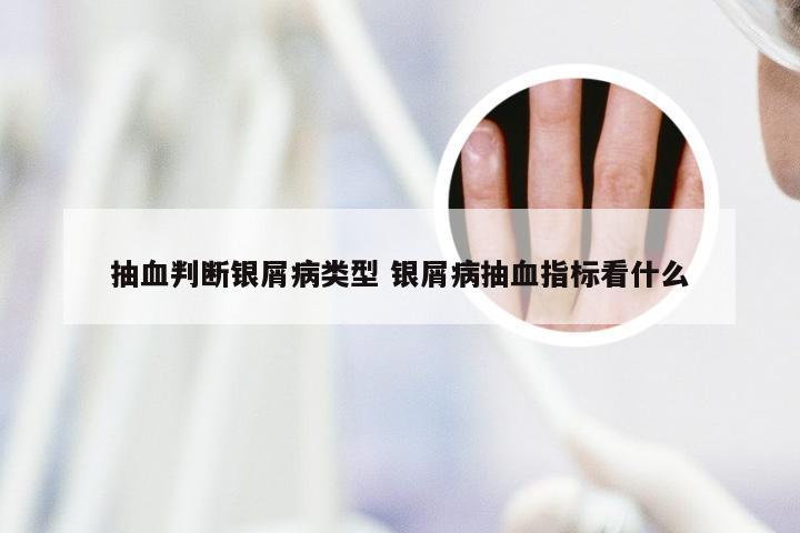 抽血判断银屑病类型 银屑病抽血指标看什么