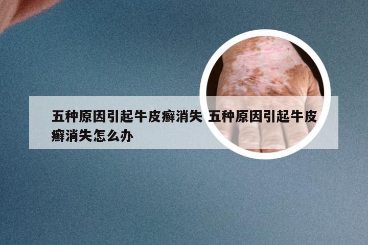五种原因引起牛皮癣消失 五种原因引起牛皮癣消失怎么办