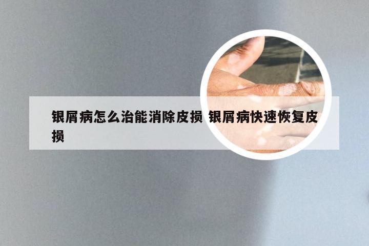 银屑病怎么治能消除皮损 银屑病快速恢复皮损