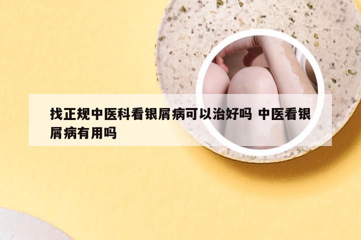 找正规中医科看银屑病可以治好吗 中医看银屑病有用吗