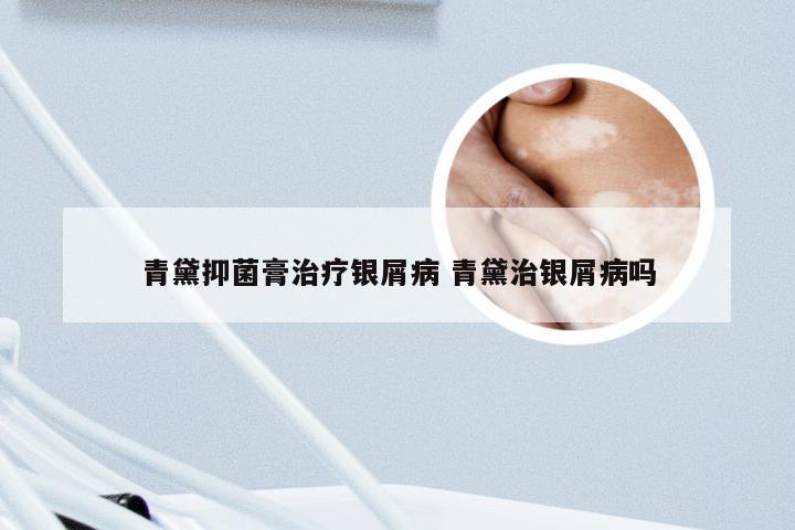 青黛抑菌膏治疗银屑病 青黛治银屑病吗