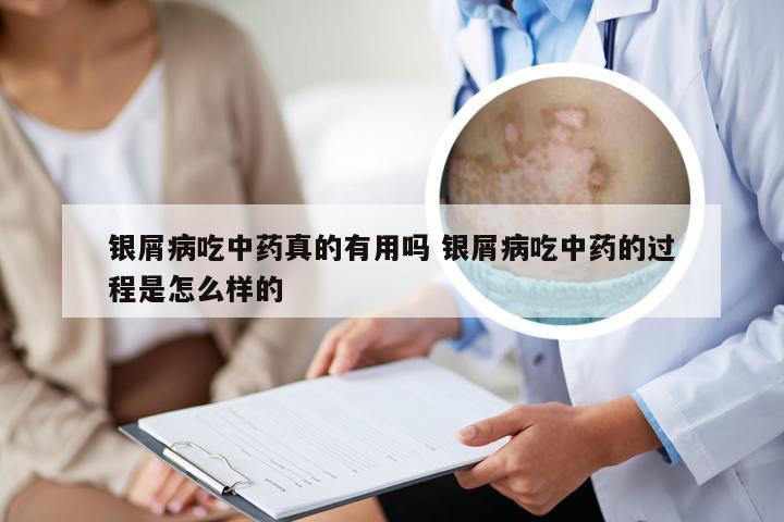 银屑病吃中药真的有用吗 银屑病吃中药的过程是怎么样的