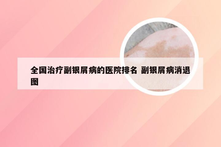 全国治疗副银屑病的医院排名 副银屑病消退图