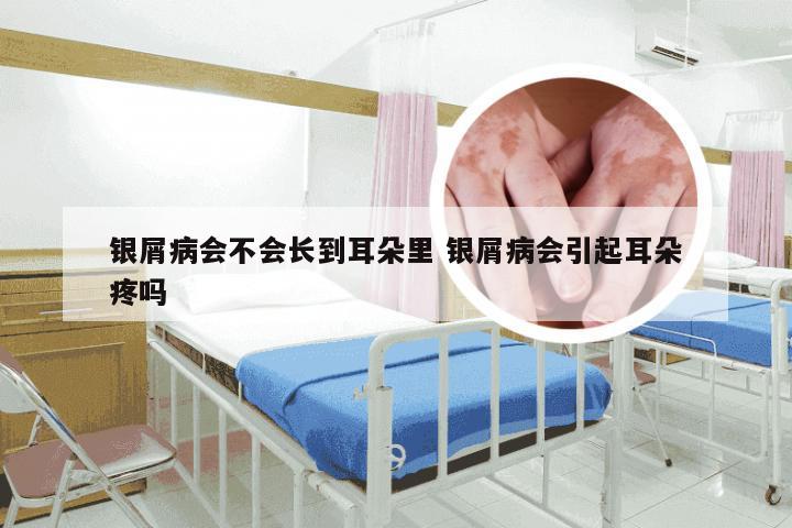 银屑病会不会长到耳朵里 银屑病会引起耳朵疼吗