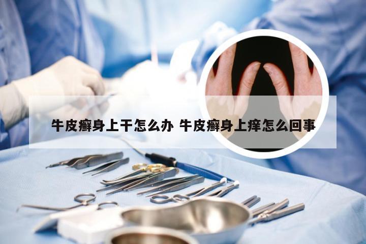 牛皮癣身上干怎么办 牛皮癣身上痒怎么回事