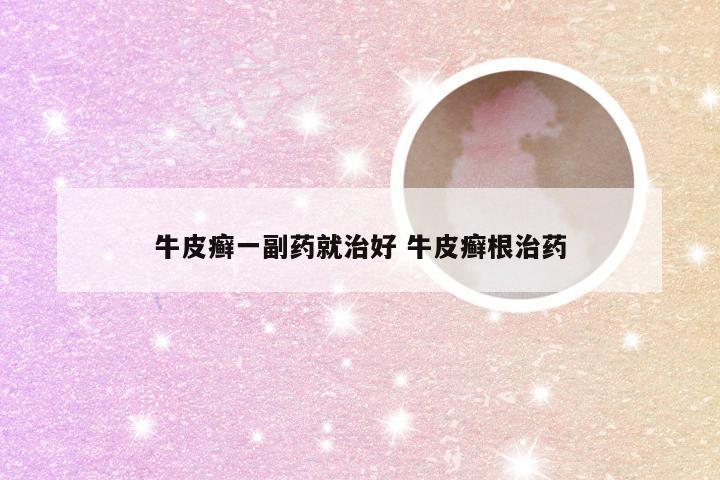 牛皮癣一副药就治好 牛皮癣根治药