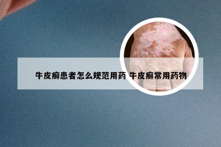 牛皮癣患者怎么规范用药 牛皮癣常用药物