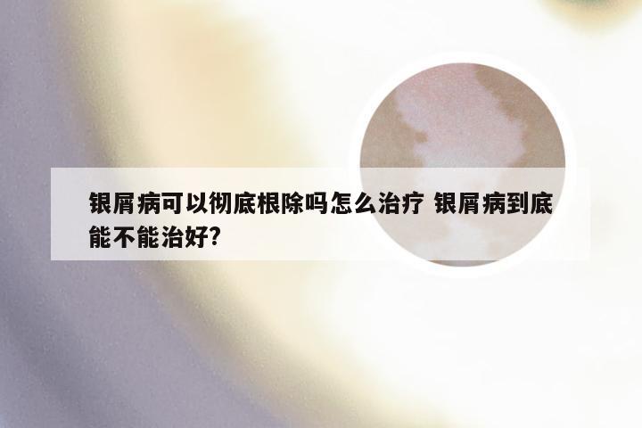银屑病可以彻底根除吗怎么治疗 银屑病到底能不能治好?