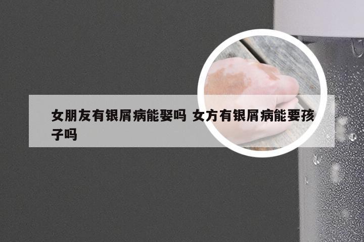女朋友有银屑病能娶吗 女方有银屑病能要孩子吗