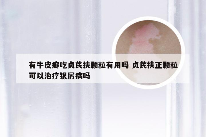 有牛皮癣吃贞芪扶颗粒有用吗 贞芪扶正颗粒可以治疗银屑病吗