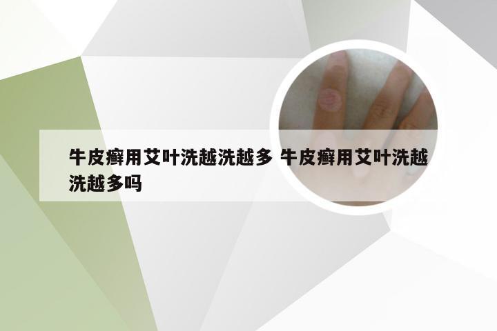 牛皮癣用艾叶洗越洗越多 牛皮癣用艾叶洗越洗越多吗