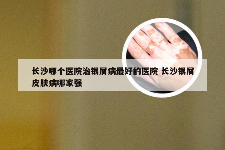 长沙哪个医院治银屑病最好的医院 长沙银屑皮肤病哪家强
