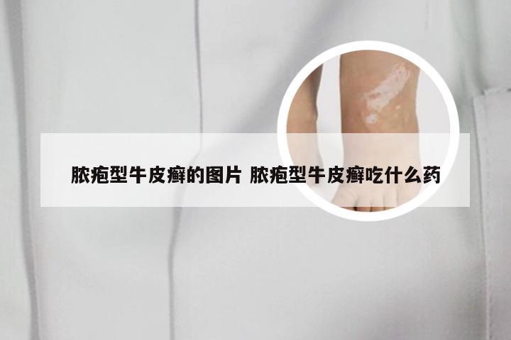 脓疱型牛皮癣的图片 脓疱型牛皮癣吃什么药
