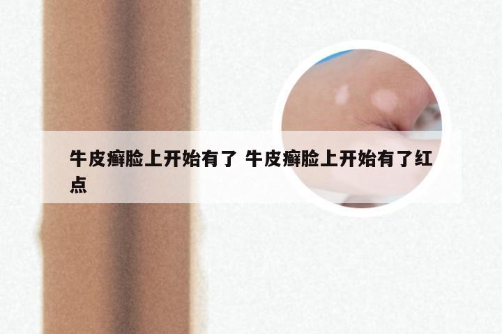 牛皮癣脸上开始有了 牛皮癣脸上开始有了红点
