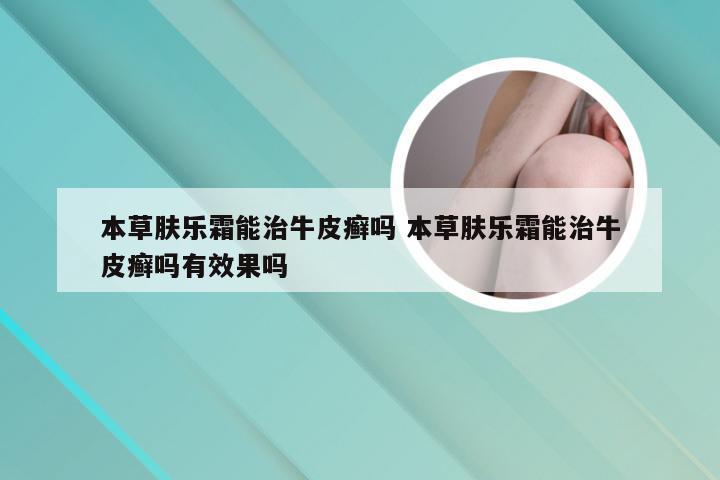 本草肤乐霜能治牛皮癣吗 本草肤乐霜能治牛皮癣吗有效果吗