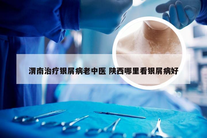 渭南治疗银屑病老中医 陕西哪里看银屑病好
