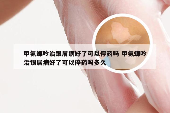 甲氨蝶呤治银屑病好了可以停药吗 甲氨蝶呤治银屑病好了可以停药吗多久