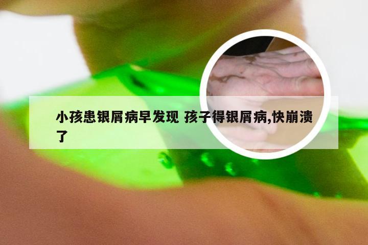 小孩患银屑病早发现 孩子得银屑病,快崩溃了