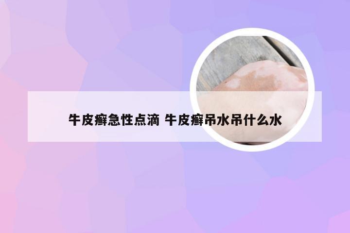 牛皮癣急性点滴 牛皮癣吊水吊什么水