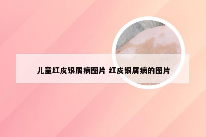 儿童红皮银屑病图片 红皮银屑病的图片