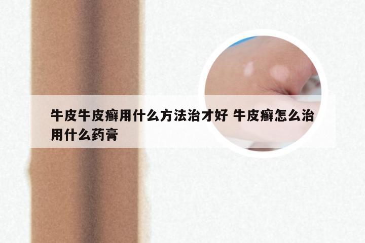 牛皮牛皮癣用什么方法治才好 牛皮癣怎么治用什么药膏