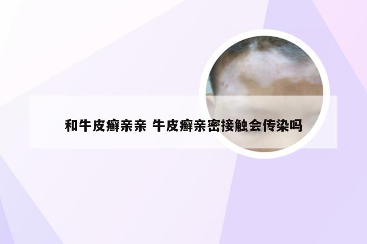 和牛皮癣亲亲 牛皮癣亲密接触会传染吗