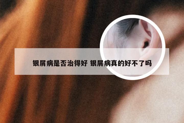 银屑病是否治得好 银屑病真的好不了吗