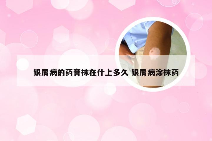 银屑病的药膏抹在什上多久 银屑病涂抹药