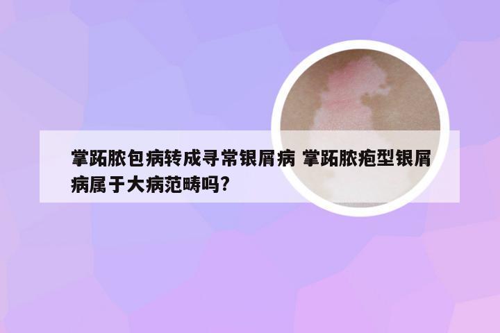 掌跖脓包病转成寻常银屑病 掌跖脓疱型银屑病属于大病范畴吗?