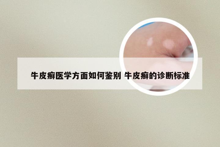 牛皮癣医学方面如何鉴别 牛皮癣的诊断标准