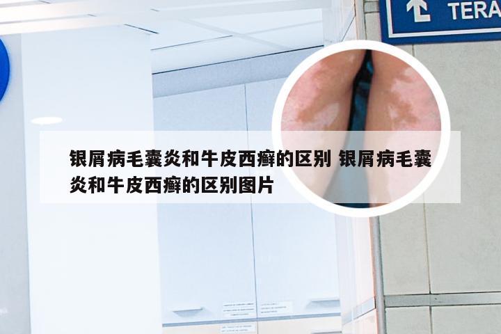 银屑病毛囊炎和牛皮西癣的区别 银屑病毛囊炎和牛皮西癣的区别图片