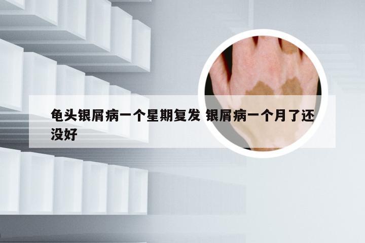 龟头银屑病一个星期复发 银屑病一个月了还没好