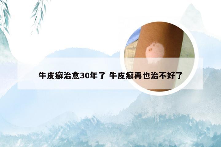 牛皮癣治愈30年了 牛皮癣再也治不好了