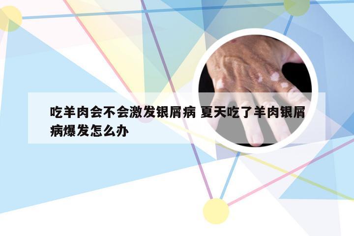 吃羊肉会不会激发银屑病 夏天吃了羊肉银屑病爆发怎么办