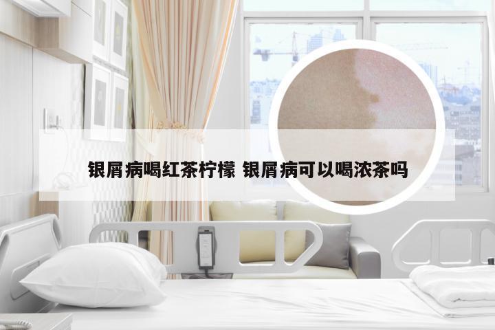 银屑病喝红茶柠檬 银屑病可以喝浓茶吗