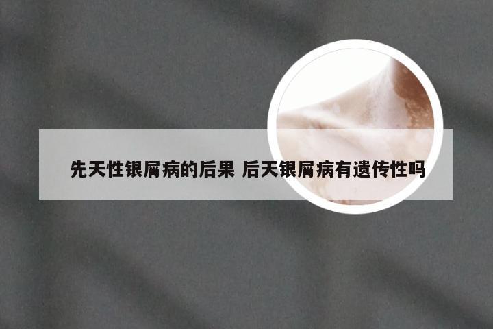 先天性银屑病的后果 后天银屑病有遗传性吗