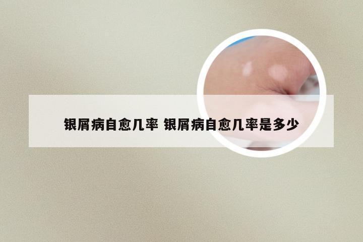 银屑病自愈几率 银屑病自愈几率是多少
