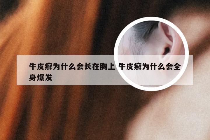 牛皮癣为什么会长在胸上 牛皮癣为什么会全身爆发