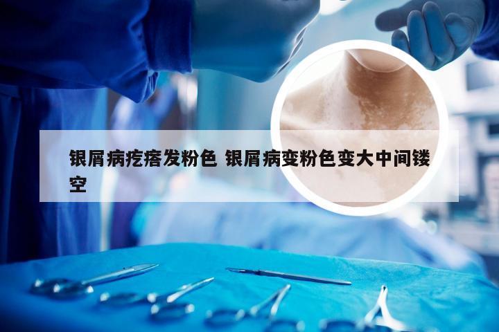 银屑病疙瘩发粉色 银屑病变粉色变大中间镂空