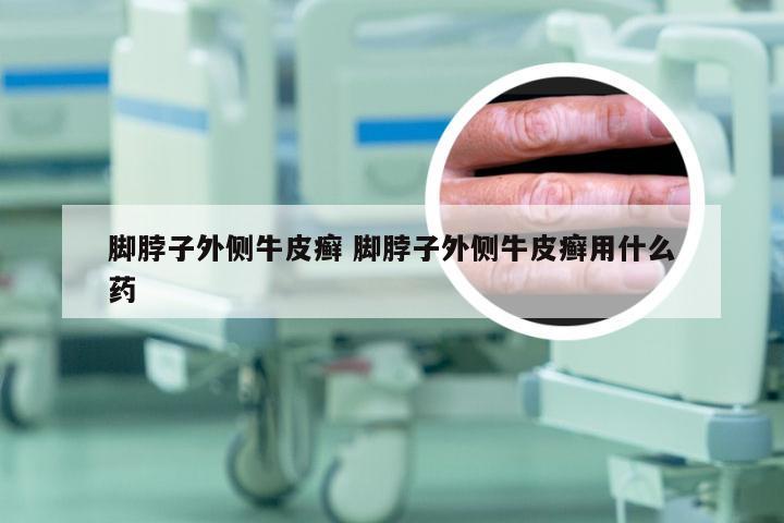 脚脖子外侧牛皮癣 脚脖子外侧牛皮癣用什么药