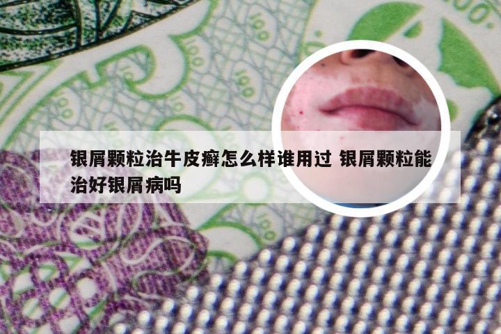 银屑颗粒治牛皮癣怎么样谁用过 银屑颗粒能治好银屑病吗