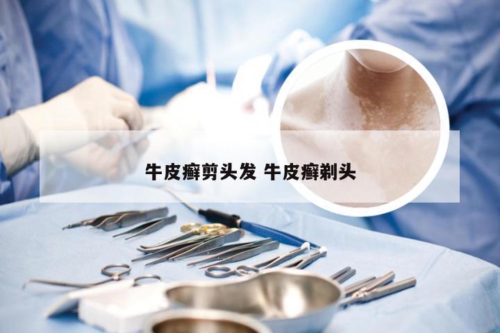 牛皮癣剪头发 牛皮癣剃头