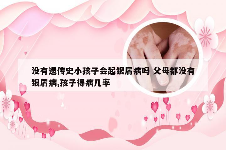 没有遗传史小孩子会起银屑病吗 父母都没有银屑病,孩子得病几率